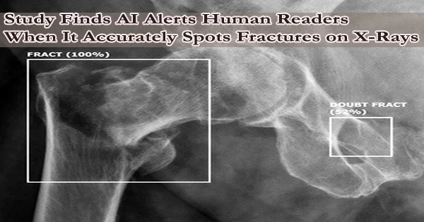 Study Finds AI Alerts Human Readers When It Accurately Spots Fractures On X Rays QS Papers