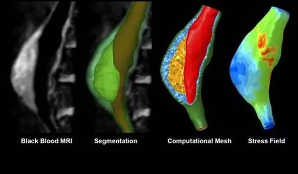 Detecting, predicting, and preventing aortic ruptures with computational modeling