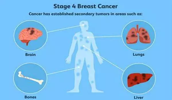 Breast cancer recurrence may be triggered by chemotherapy injury to non-cancer cells