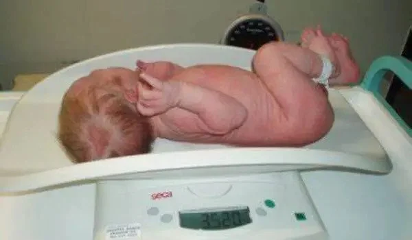 Birth weight could help identify children at higher risk of psychological issues