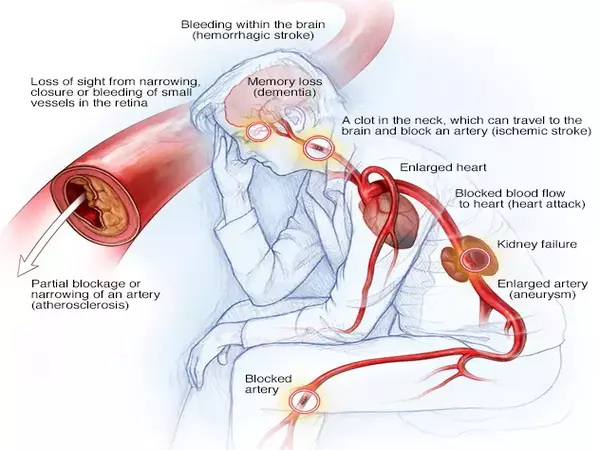 High blood pressure while lying down linked to higher risk of heart health complications