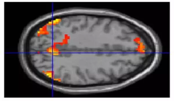 Researchers use MRI to show brain changes, differences in children with ADHD