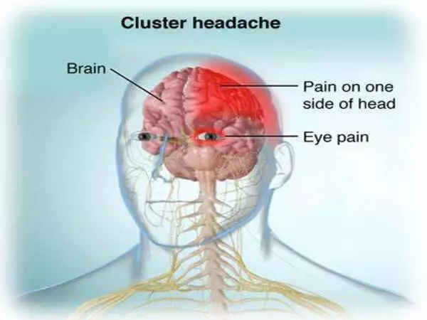 Cluster headache may be more severe in women