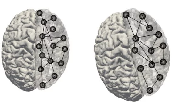 Stunting in infancy linked to differences in cognitive and brain function